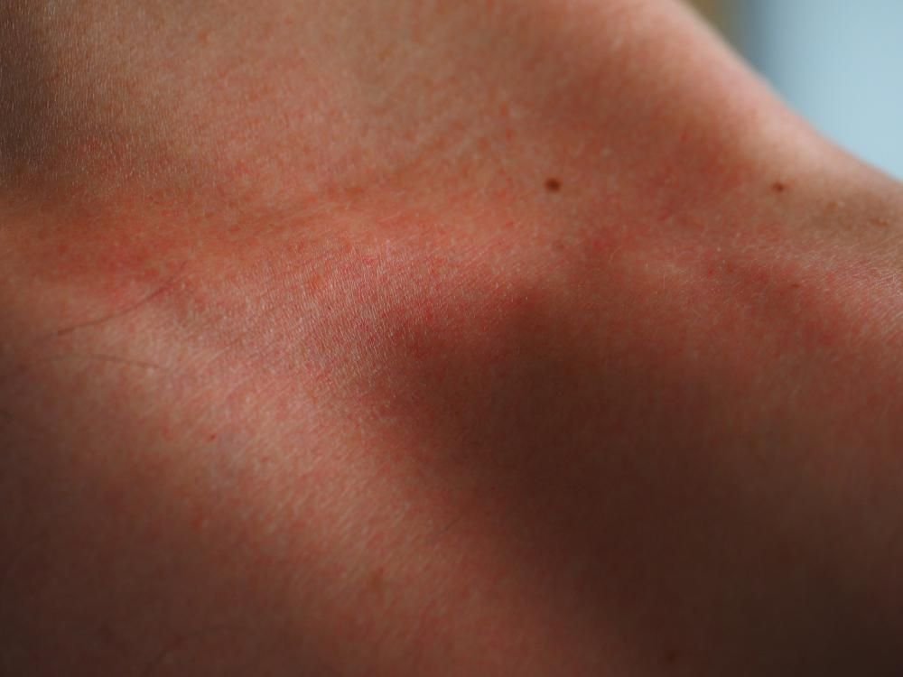 Терапия гнойничковых заболеваний кожи