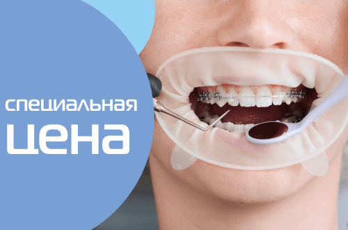Специальная стоимость на брекет-систему DAMON Q